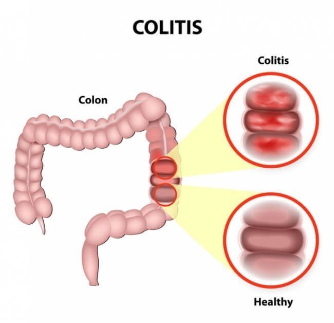 Ulcerative colitis симптомы