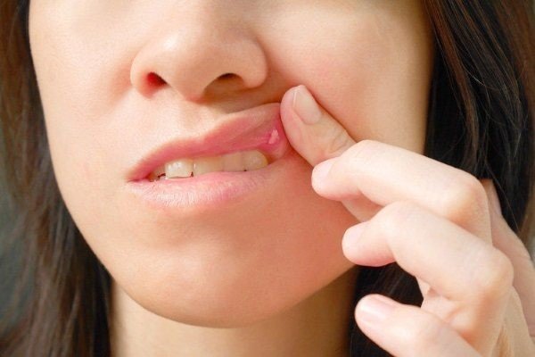 Заболевания слизистой оболочки полости рта